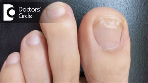 Causes Of White Spots On Your Toenails – My FootDr | atelier-yuwa.ciao.jp