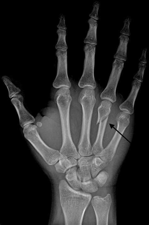 Metacarpal Fracture Treatment - Manchester Hand & Wrist Surgery