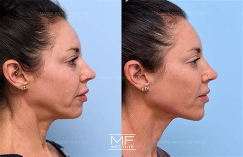 Jawline Fillers Before After Results At Skinly, 55% OFF