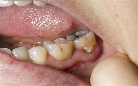 Pictures Of Cavities In Teeth - 25 Things That Make You More Likely To ...