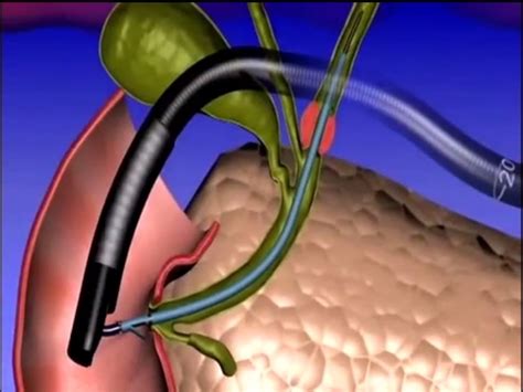 Ercp Stent