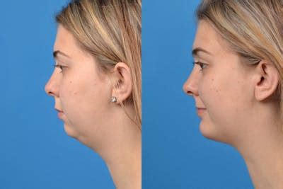 Chin Augmentation Before & After Photos | Clevens Face and Body Specialists