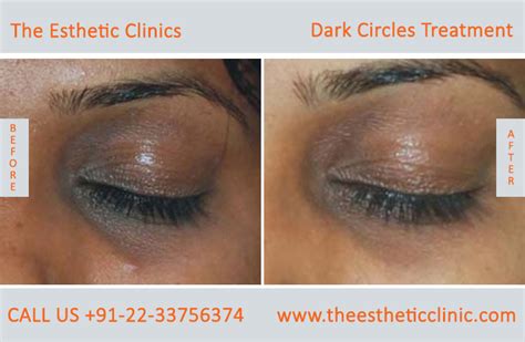 The best under eye dark circles treatments available - Dr Rinky Kapoor