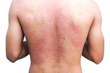 Miliaria Rubra | Sweat Rash | Treatment, Causes and Prevention - SwitSmell