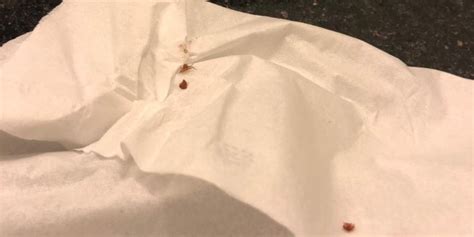 Disneyland Hotel sued after woman claims bedbugs ruined vacation: 'She was absolutely butchered ...