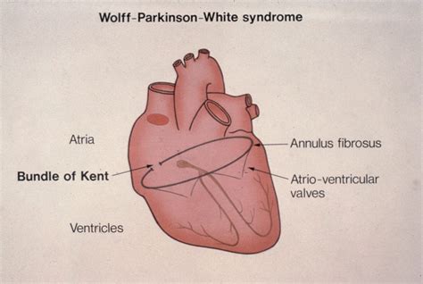 Bundle Of Kent Anatomy