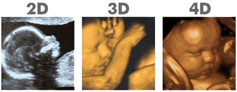 3D ultrasound Atlanta, 4D ultrasound, HD Ultrasound Atlanta, GA