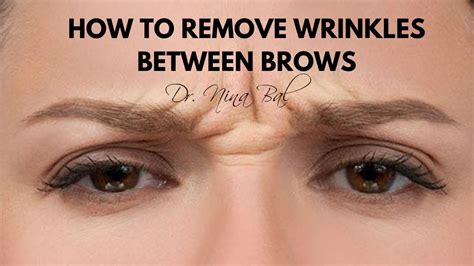 How To Get Rid Of Wrinkles Between Eyebrows 💕 Dr Nina Bal, Glabellar Lines Removal - YouTube