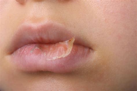 Dermatitis On Lips Symptoms | Lipstutorial.org