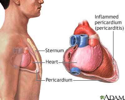 Pericarditis - Symptoms and Causes