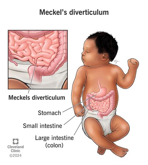 Meckel’s Diverticulum: Symptoms, Diagnosis & Treatment