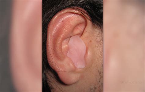 Ear wax build up | General center | SteadyHealth.com