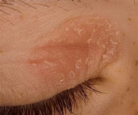 Eczema On Eyelid Symptoms Causes Pictures Treatment | Images and Photos ...