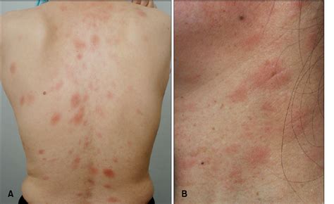 Figure 1 from Generalized Eczema-like Eruption in a Patient Treated with Interferon Alpha-2b and ...