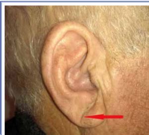 Earlobe Crease And Heart Disease: Is It Real? Review Of Evidence - Joe ...