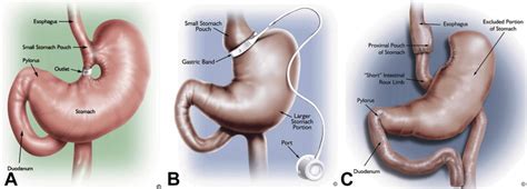 The role of endoscopy in the bariatric surgery patient - Gastrointestinal Endoscopy