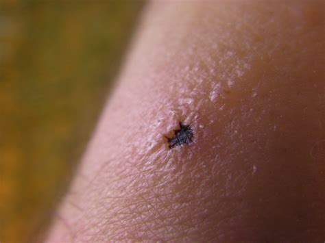 spider bite day #2 | A look at my brown recluse spider bite … | Flickr