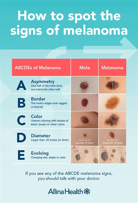Melanoma and your moles: Know what's new | Allina Health