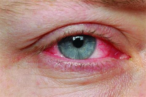 Pink Eye: Symptoms, Causes, Types & Treatment » How To Relief
