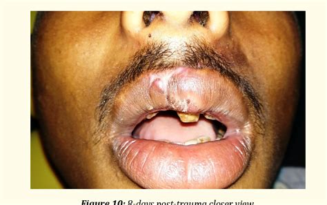 Figure 1 from Primary Intention Wound Healing and Esthetic Restoration in a Lacerated Lip Wound ...