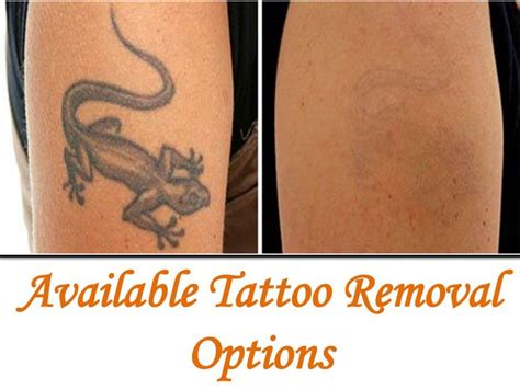 PPT - Available Tattoo Removal Options PowerPoint Presentation, free download - ID:7422098