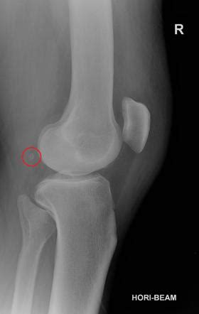 Fabella | Radiology Reference Article | Radiopaedia.org