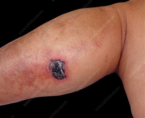 Pyoderma gangrenosum - Stock Image - C032/0477 - Science Photo Library