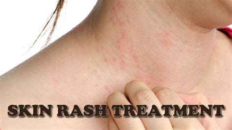 Real Info About How To Treat A Skin Rash - Loadexam