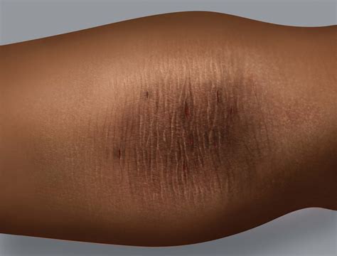 Eczema on dark skin | Eczema Foundation