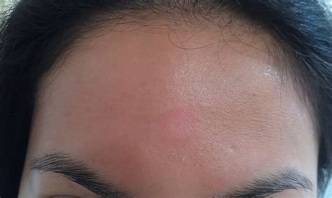 Alcohol Seizures Treatment: Eczema On Forehead Treatment