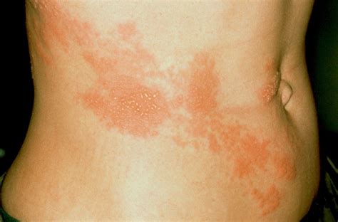 Shingles: what are the symptoms and treatment for the condition | GoodTo