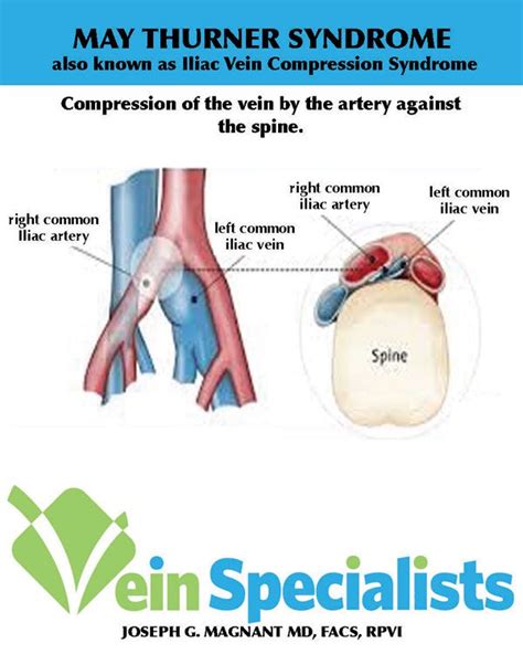 Pelvic Congestion Syndrome Treatment | Get Relief