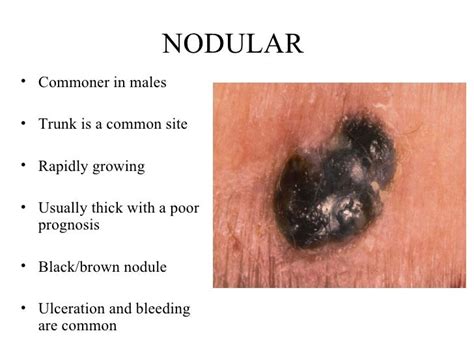 nodular melanoma pictures - pictures, photos