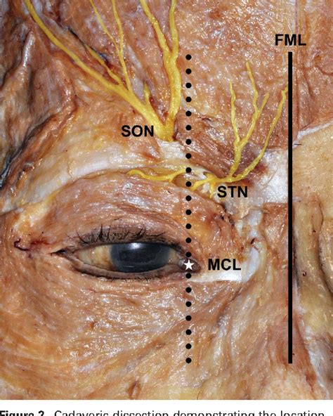 Nerve Blocks On The Face Scalp Supraorbital Greater O - vrogue.co