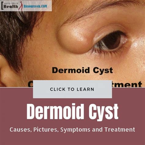 Dermoid Cyst Definition Causes Symptoms And Dermoid Cyst Treatment ...