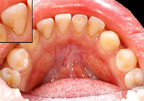 Causes Of Gum Disease Asheville - Dentist Asheville 28704