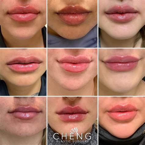 Cheng Plastic Surgery & Medspa on Instagram: “Lip Inspo ⁣ ⁣ Here is ...