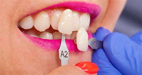 What Are Veneers? | Learn About Different Veneers & Their Benefits