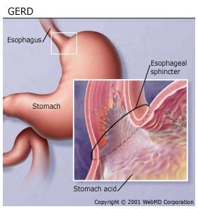 Reasonably Well: Sjogren's Syndrome and Gastroesophageal Reflux Disease