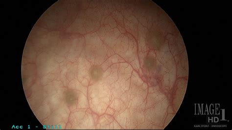 Cystitis Cystica on Routine Cystoscopy at Time of Total Laparoscopic ...