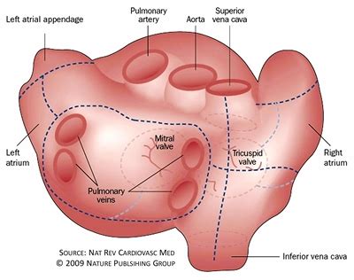 Cox Maze, Mini-Maze & Hybrid Surgeries - Atrial FibrillationAtrial ...