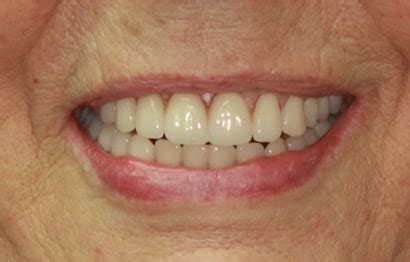 Smile Transformations: Dental Implants Before & After