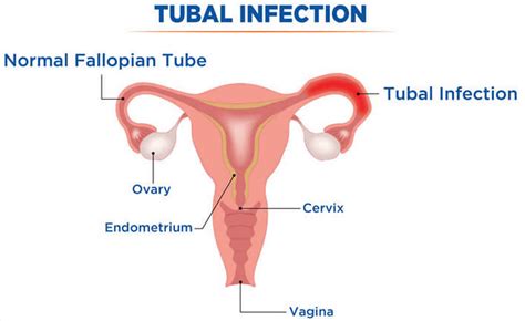 Salpingitis acute & chronic causes, symptoms, diagnosis and treatment