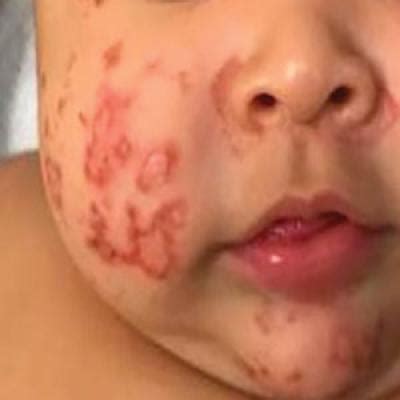 Acquired Acrodermatitis Enteropathica in an Infant | MDedge Dermatology