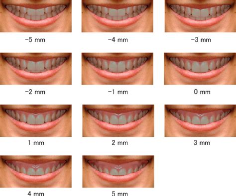 Figure 2 from Influence of gingival display on smile aesthetics in ...