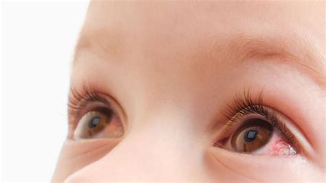 Baby Red Around Eyes: Causes, Remedies, And Treatment