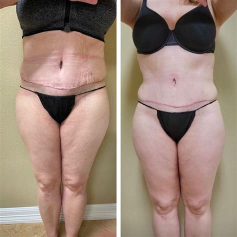 Plastic Surgery Recovery Gallery – atruerecovery