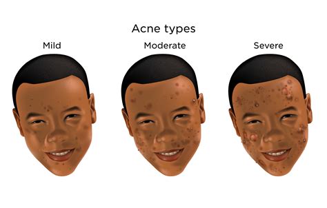 Moderate Acne | My Doctor Online