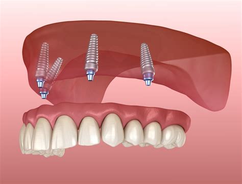 Implantes dentales ALL on 4 - Zirconia Clínica Dental Quito