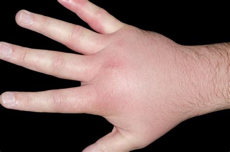 Cellulitis Of The Hand Photograph by Dr P. Marazzi/science Photo Library